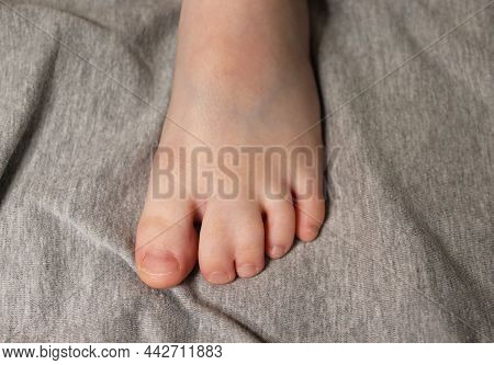 Hereditary Disease. The Foot Of A Little Boy With Syndactyly.