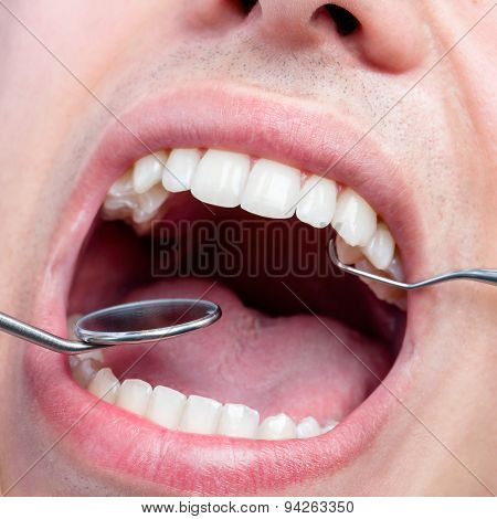 Human Male Mouth Showing Teeth With Dental Hatchet And Mouth Mirror.