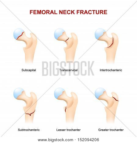Femoral neck fracture. Major types. vector illustration