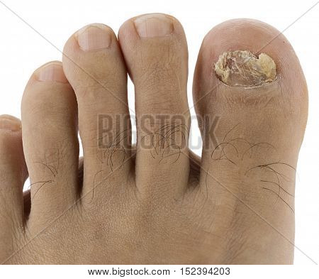 Toenail Fungus