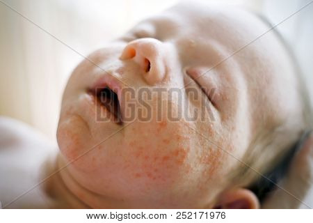 Newborn Baby Boy Face With Many Red Spots