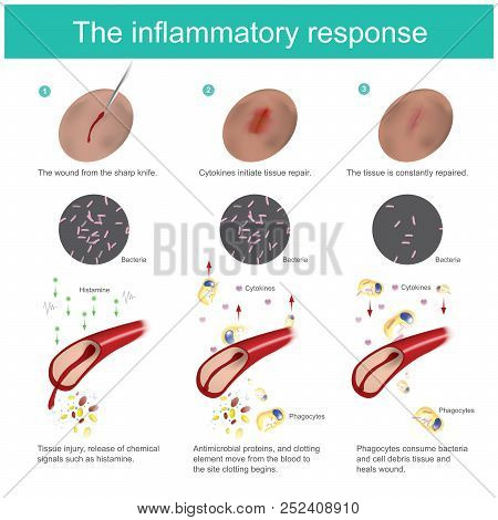 The Inflammatory Response. When The Skin Tissue Is Damaged, The Body Will Produce Immunity, Eliminat