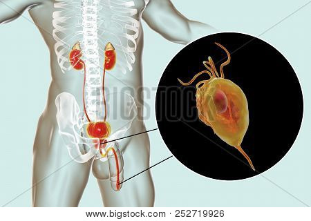 Trichomoniasis Infection In Man, 3d Illustration Showing Male Anatomy Genitourinary System And Close