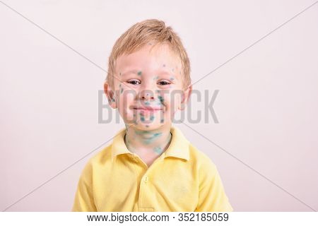 Young Toddler,boy With Chickenpox. Sick Child With Chickenpox. Varicella Virus Or Chickenpox Bubble