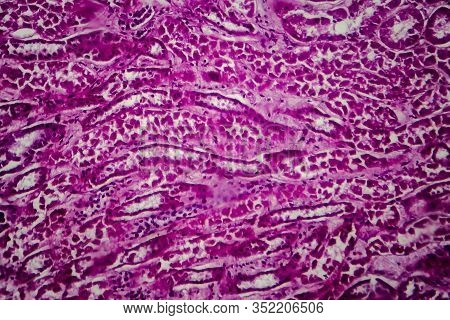 Histopathology Of Diffuse Sclerosing Glomerulonephritis, Light Micrograph, Photo Under Microscope