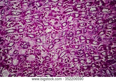 Histopathology Of Diffuse Sclerosing Glomerulonephritis, Light Micrograph, Photo Under Microscope