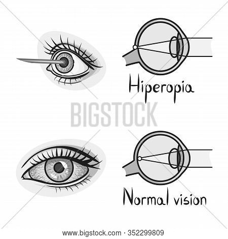 Vector Illustration Of Vision And Correction Icon. Collection Of Vision And Optometry Vector Icon Fo