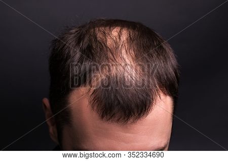 Male Head Close-up With Baldness. Studio Black Background.