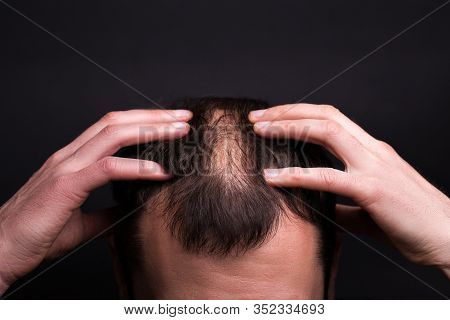 Male Head Close-up With Baldness. Studio Black Background.