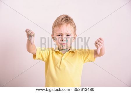 Young Toddler,boy With Chickenpox. Sick Child With Chickenpox. Varicella Virus Or Chickenpox Bubble