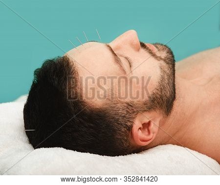 Man Has A Headache. Acupuncture Treatment For Migraines. Close-up Acupuncture Needles In A Mans Fore