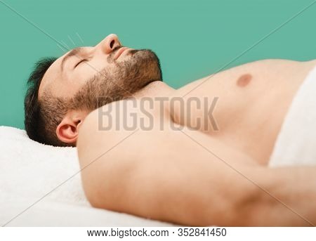 Man Caucasian Race Undergoing Acupuncture Treatment At The Spa Salon. Acupuncture - An Ancient Treat