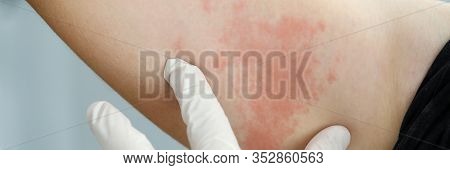 Focus On Hand In Glove Of Professional Doctor Looking At Painful Dermatological Infection Spreading 