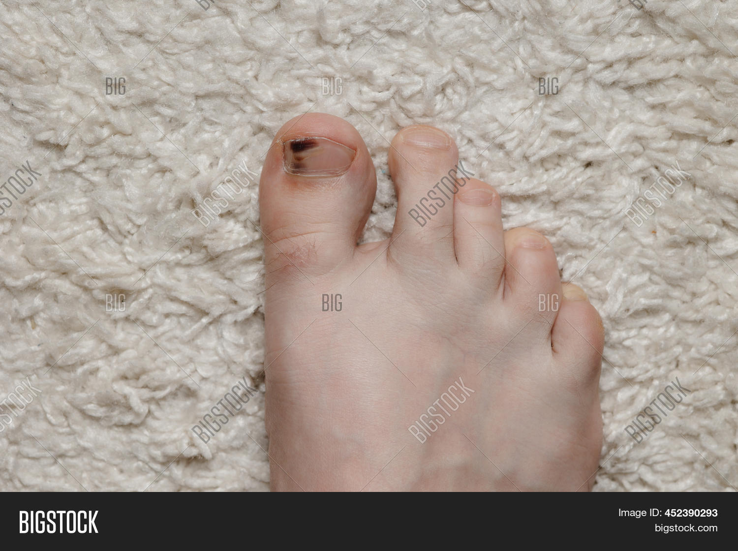 Subungual Hematoma Image & Photo (Free Trial) Bigstock