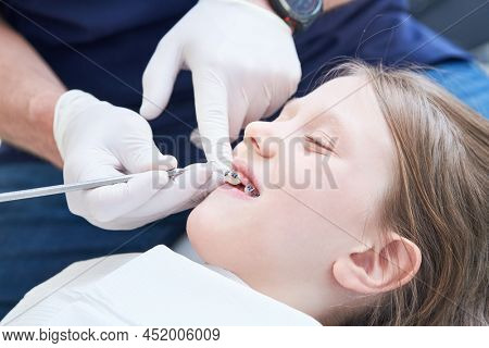 Braces for child teeth correction. Installation and maintenace
