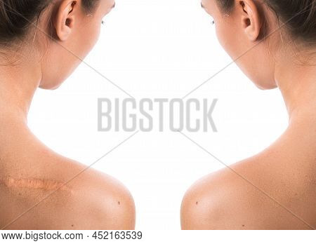 Comparision Of Female Shoulder After Scar Removing