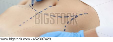 Doctor Plastic Surgeon Drawing Preoperative Markings On Skin Of Patient Abdomen Closeup. Plastic Sur