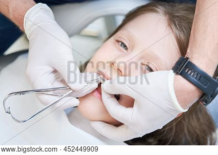 Braces for child teeth correction. Installation and maintenace
