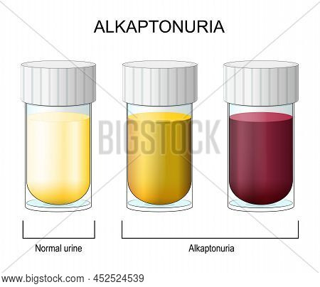 Alkaptonuria. Color Change In Urine From Normal To Alkaptonuria. Laboratory Flasks With Urine. Compa