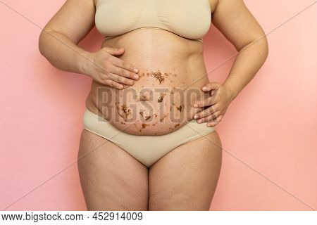 Cropped Of Overweight Fat Woman Holding Tummy, Flabs With Obesity, Excess Fat In Underwear, Applying