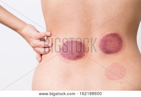 Woman blood marks massaged with cupping therapy