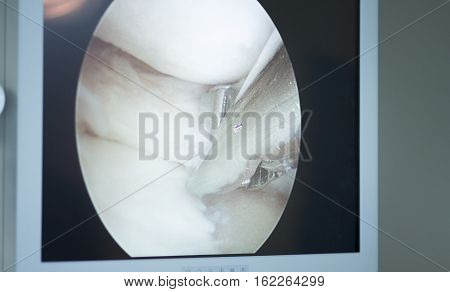 Arthroscopy Surgery Screen