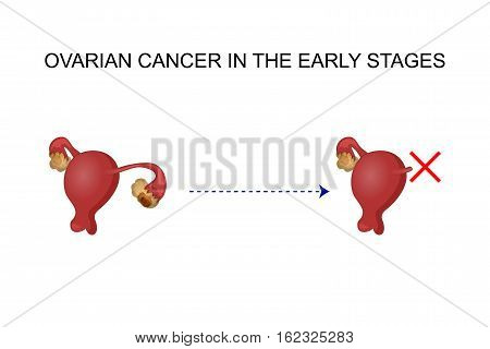 vector illustration of problems of the reproductive system. for medicinskih publications..