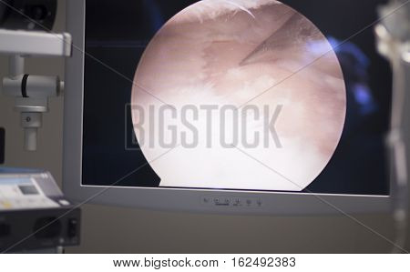 Arthroscopy Surgery Screen