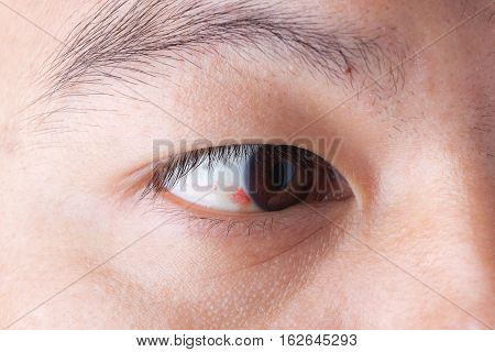 Close Up Of Ubconjunctival Hemorrhage In Eye