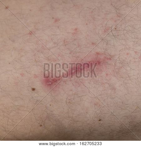 Irritant contact dermatitis at man leg close up.. Pederus-dermatitis - Allergic reaction to the blood type of beetles Paederus characterized by vesicular dermatitis