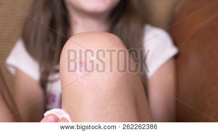 Wounded Knee Of The Child, Abrasions On The Girl's Lap. Close-up. Pour Hydrogen Peroxide On Abrasion