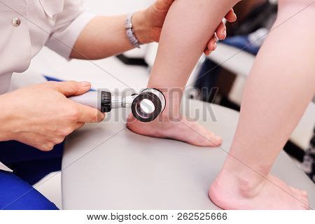 Melanoma Diagnosis. The Doctor Examines The Patient's Mole