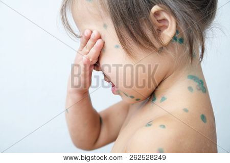 Child With Chickenpox. Sick Little Girl  With Varicells Making Eruption On Skin. Long Home Quarantin