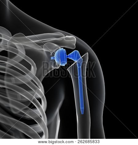 3d rendered medically accurate illustration of a shoulder replacement