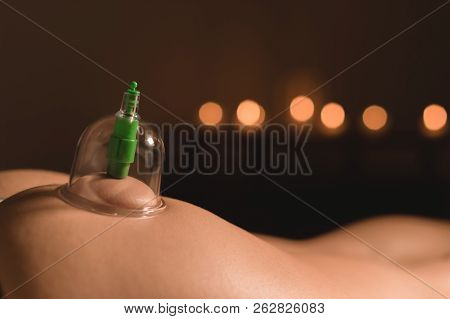 Close-up Of Wet Caps For Vacuum Massage Installed On The Buttock Of A Young Girl On The Background O