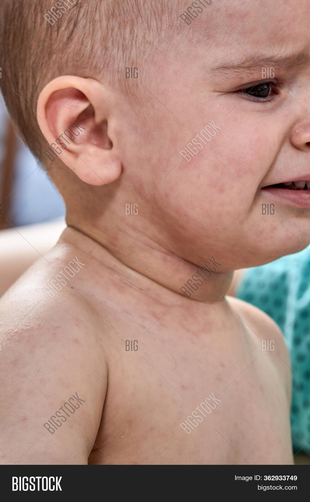 Roseola Rash Viral Image & Photo (Free Trial) Bigstock