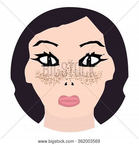 Freckles On The Face. Pigmentation On The Skin. A Pigmented Spot On The Skin Of The Face. Before And