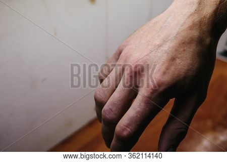 Psoriasis Skin. Psoriasis Is An Autoimmune Disease That Affects The Skin Cause Skin Inflammation Red