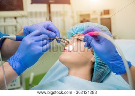 Laser Vaporization Of Nasal Concha With Coblation Technology Method