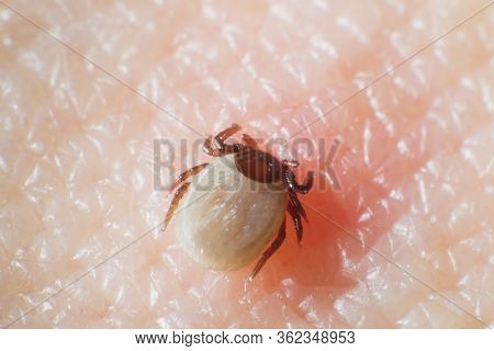 Mite Are Sucking Blood From A Human Skin