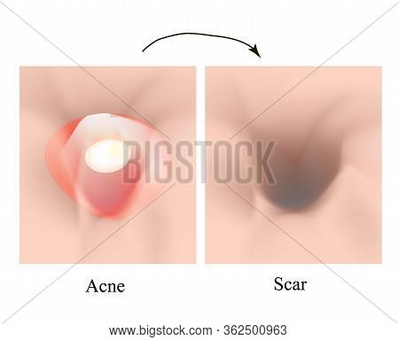 Atrophic Scars. Acne Scar. The Anatomical Structure Of The Skin With Acne. Illustration On Isolated 