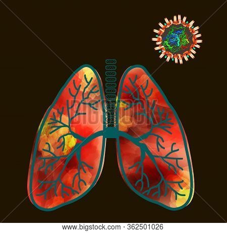 Coronavirus Atypical Polysegmental Pneumonia. Inflammation Of The Lungs Coronavirus Covid 19. Influe
