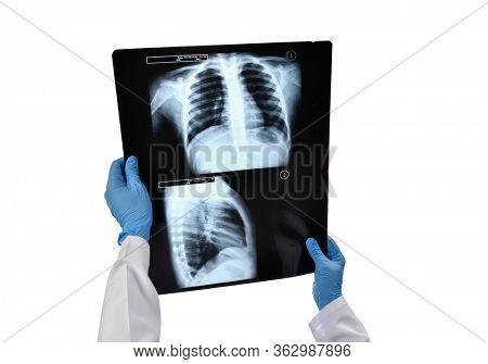 Chest X-ray emerges as frontline tool for coronavirus COVID-19  
