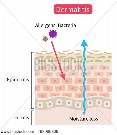 Atopic Dermatitis (eczema) Dry Skin Disrupt Moisture Barrier That Allows Penetrate External Stimuli.