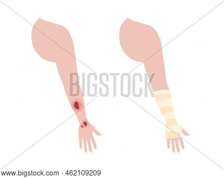 Sore, Cut Or Ulcer On Human Arm. Elastic Bandage, Wrap Medical Gauze Over Forearm. Healthcare Concep
