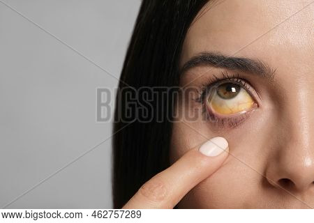 Woman Checking Her Health Condition On Grey Background, Closeup. Yellow Eyes As Symptom Of Problems 
