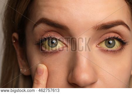 Woman Checking Her Health Condition, Closeup. Yellow Eyes As Symptom Of Problems With Liver