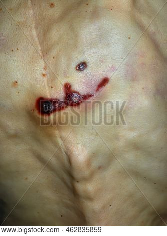 Antemortem Pressure Ulcers On The Back Of An Extremely Thin Cadaver From Anorexia, Forensic Studies,