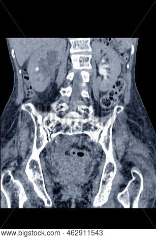 Blurry Ct Scan Lower Abdomen Severe Hydronephrosis Rt Kidney With Distal Ureteric Obstruction, May D