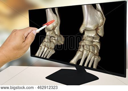 The Doctor Informed The Results Of X-ray Images Of The Ankle And Found Distal Tibia Bone Abnormaliti
